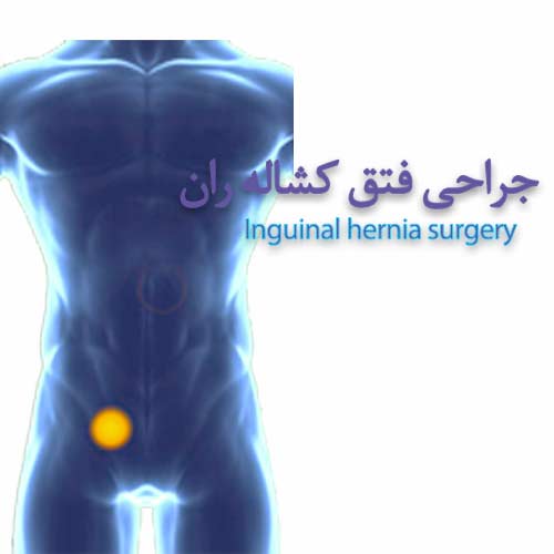 Inguinal hernia surgery جراحی لاپاراسکوپی