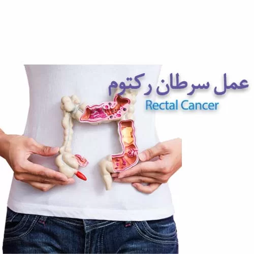 Rectal cancer عمل سرطان گوارش