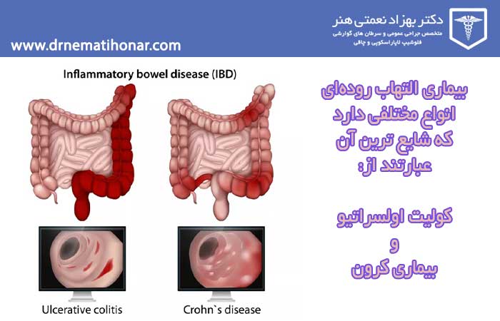 Types of inflammatory bowel disease