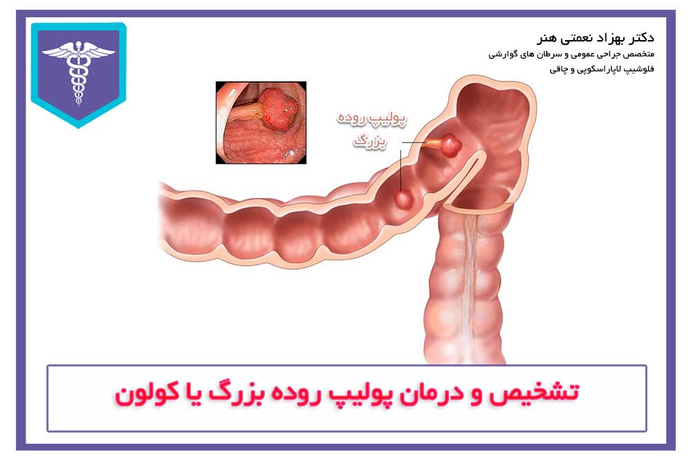 Diagnosis and treatment of colon polyps