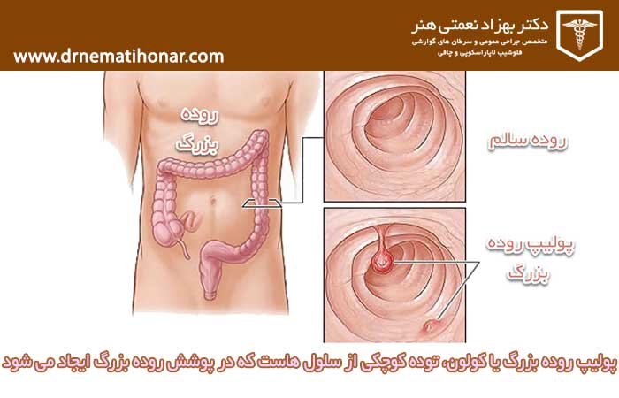 Normal colon and colon polyps